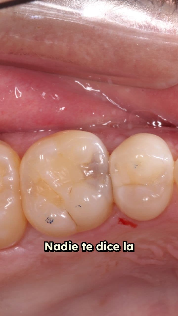 Caries ocultas bajo empastes viejos