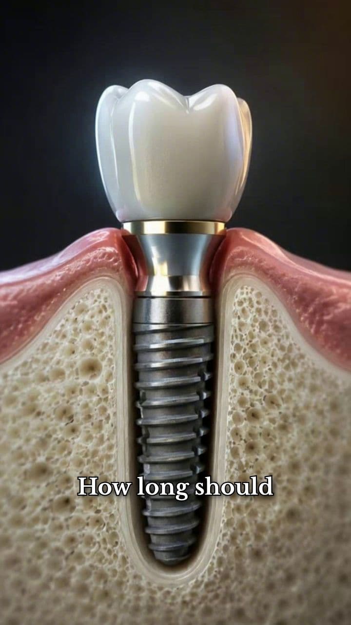 Dental Implants at 25 Years
