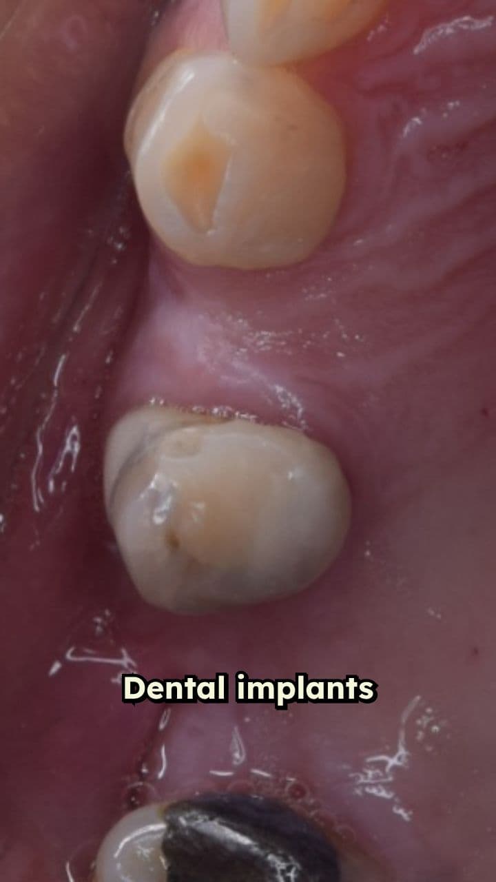 The Real Dental Implant Process