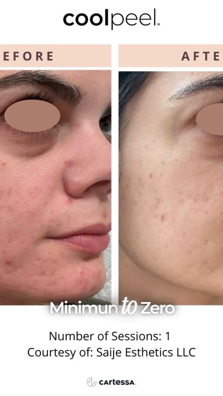 Zero-Downtime CoolPeel CO2 Rejuvenation
