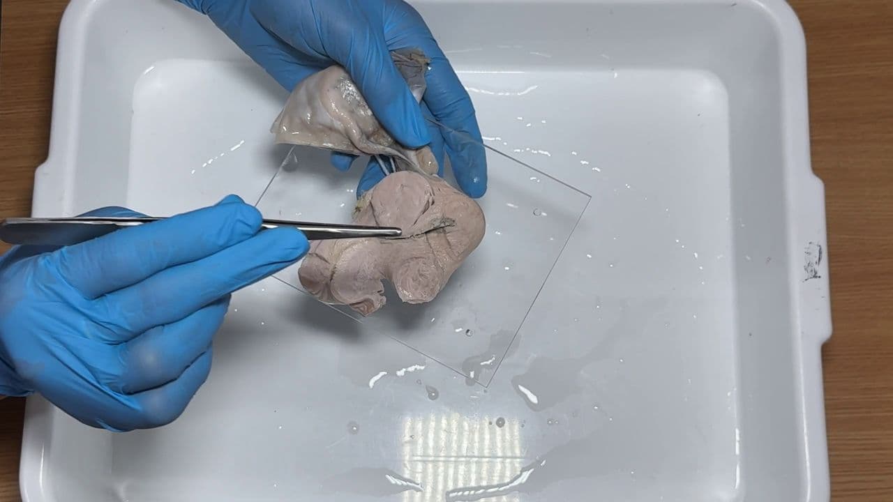 Understanding Leiomyoma in Hysterectomy Cases