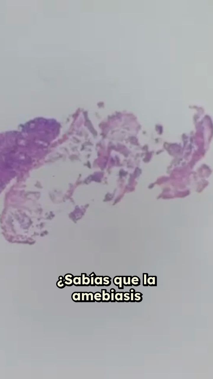 Amebiasis colónica: infección y síntomas