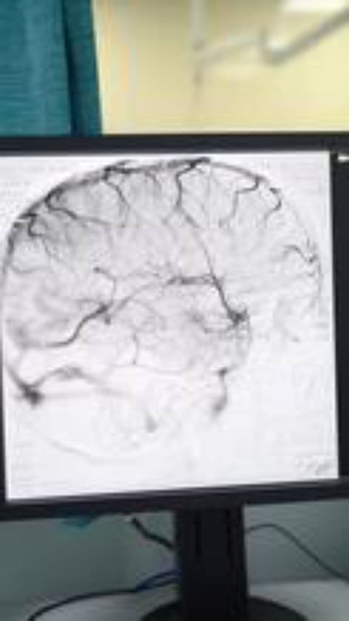 Causes of Seizures Explained