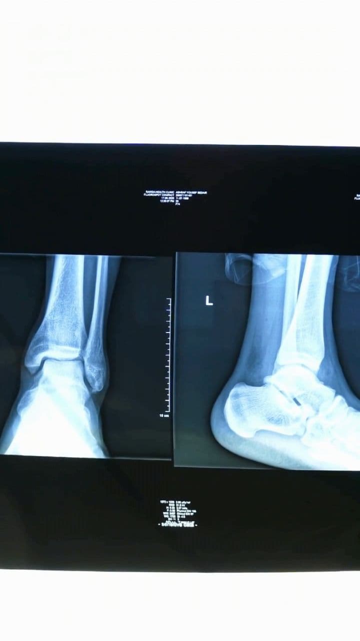 Surgery Isn't Always Necessary for Pain