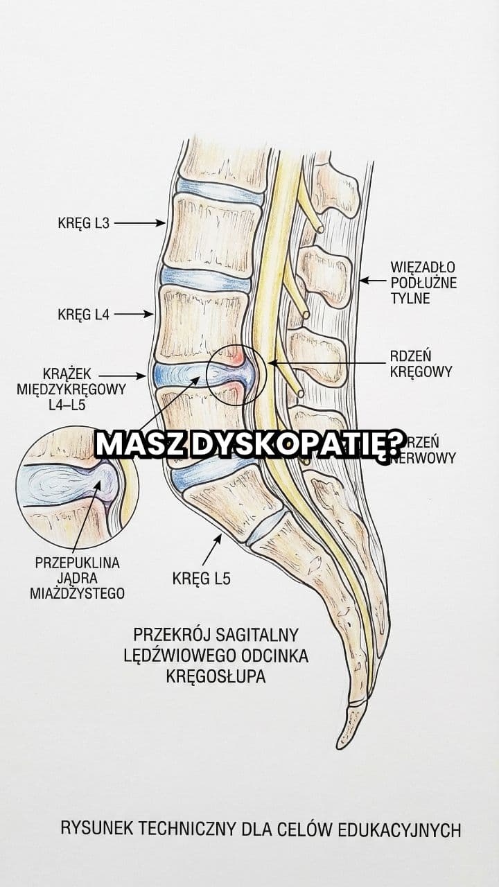 Dyskopatia: bezpieczne ćwiczenia zamiast masaży