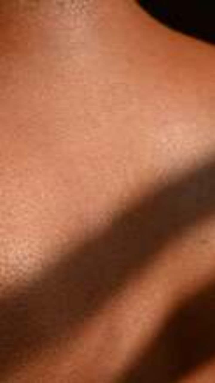 Pimple Popping & Blackhead Removal