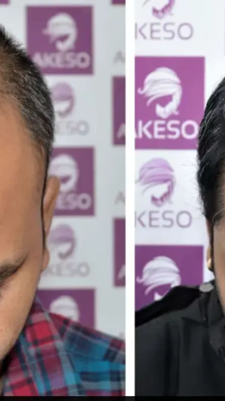 Premium Hair Transplant Services in Delhi