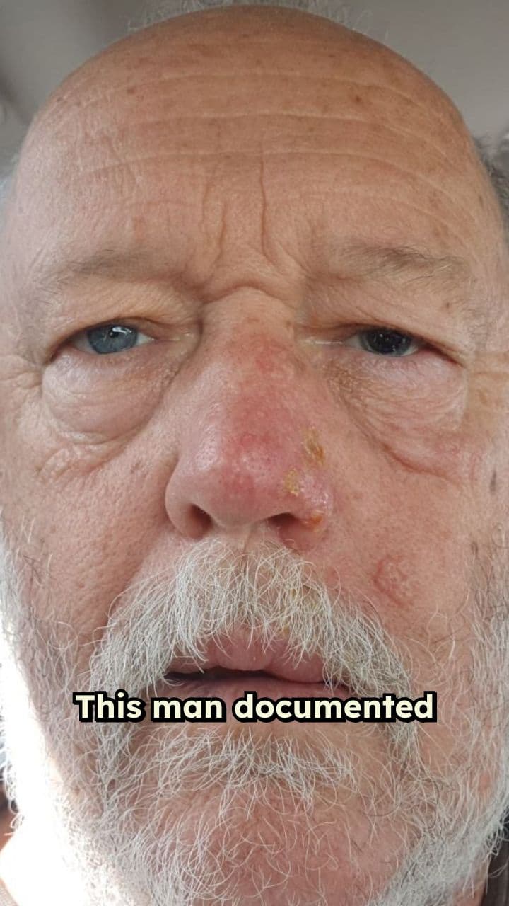 Shocking Shingles: A Daily Documentation