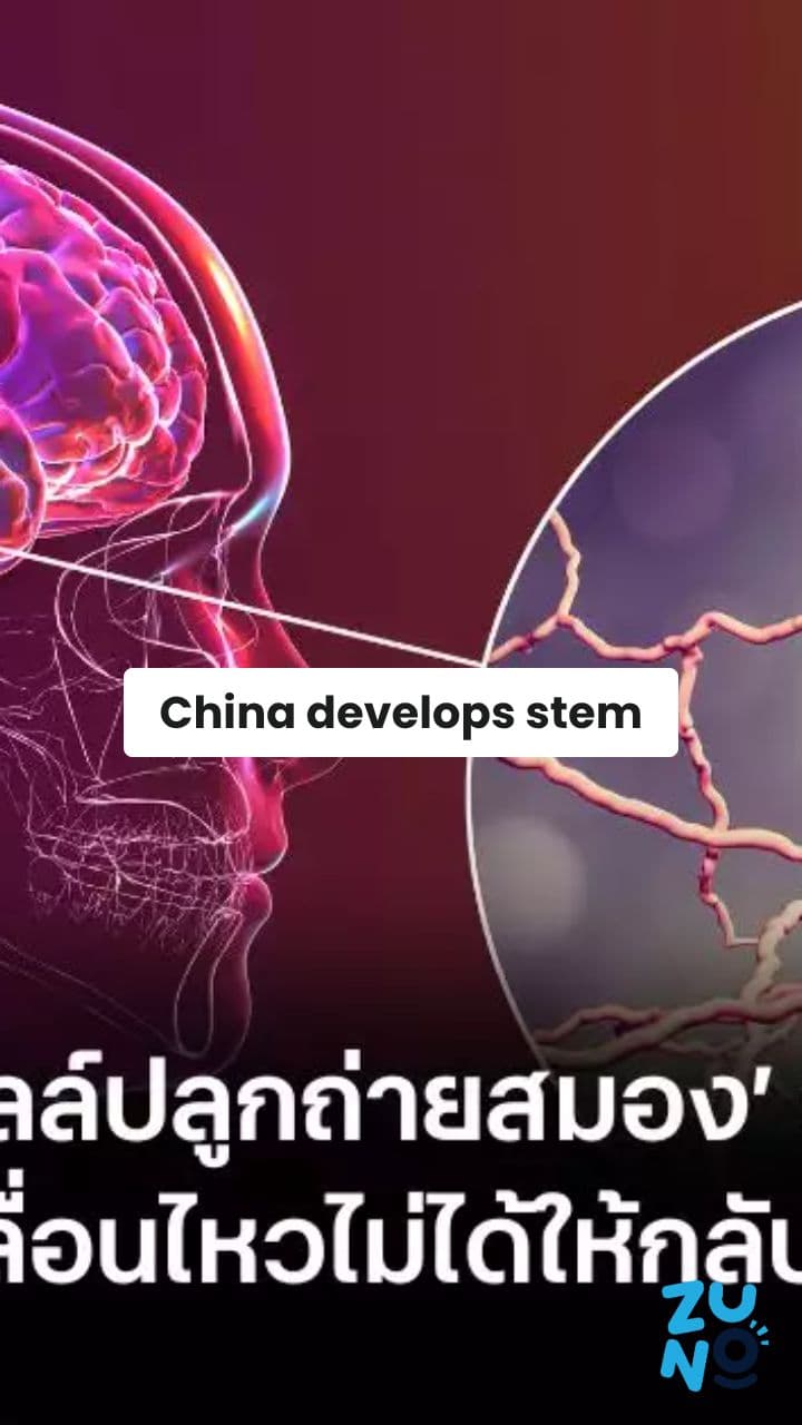 China Develops Stem Cell Treatment for Parkinson's