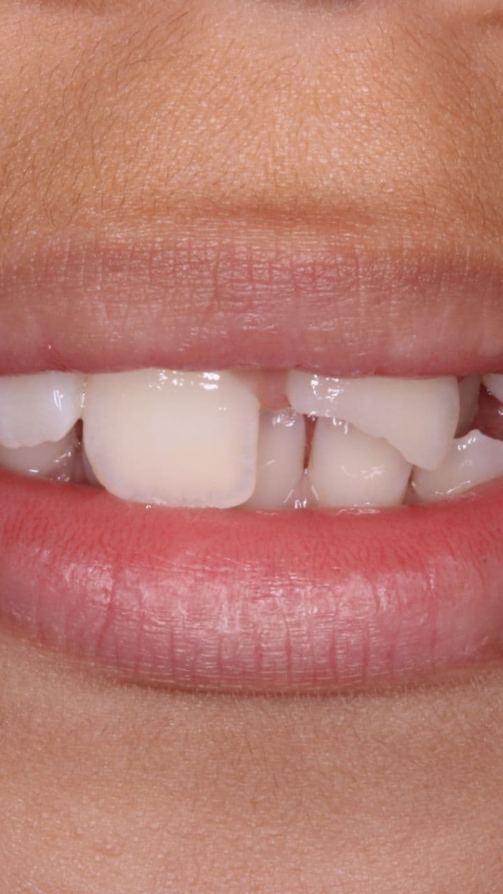 Processo Restaurador Dental